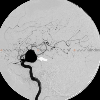 На селективной церебральной ангиографии (вид сбоку) видна гигантская аневризма левой внутренней сонной артерии.